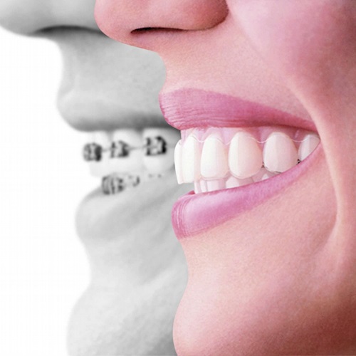 Ortodontik Tedavi Ne Kadar Sürer